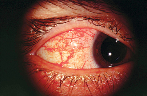 Реферат: Воспалительные заболевания коньюнктивы и оболочек глаза